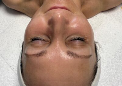 Pleť po ošetření Rejulift